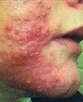 Acne Treatments