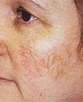 Thread Veins