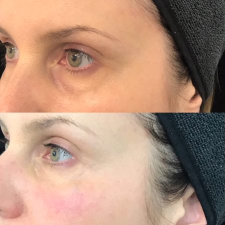 Before and after Tear Trough Filler