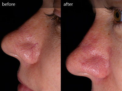 can you get rid of red thread veins on face